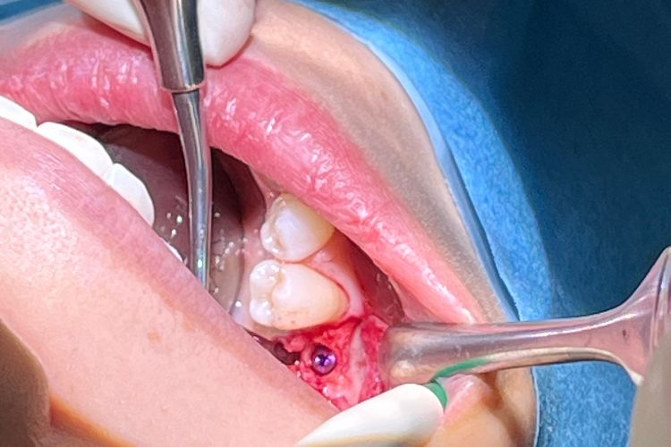 Implantatgetragene Krone – ästhetischer Zahnersatz ohne Beschleifen